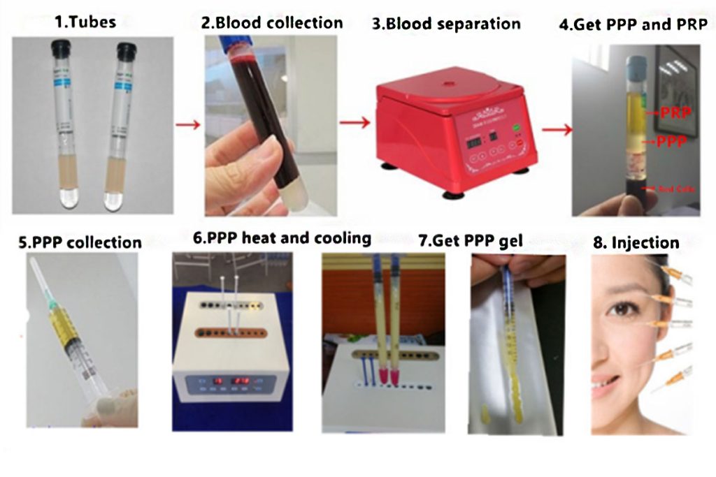 Using Process of PPP Autologous Collagen Transplantation