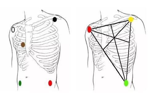 Difference between 3-lead and 5-lead ECG leads